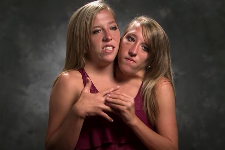 Siamese-tweeling-nieuws 