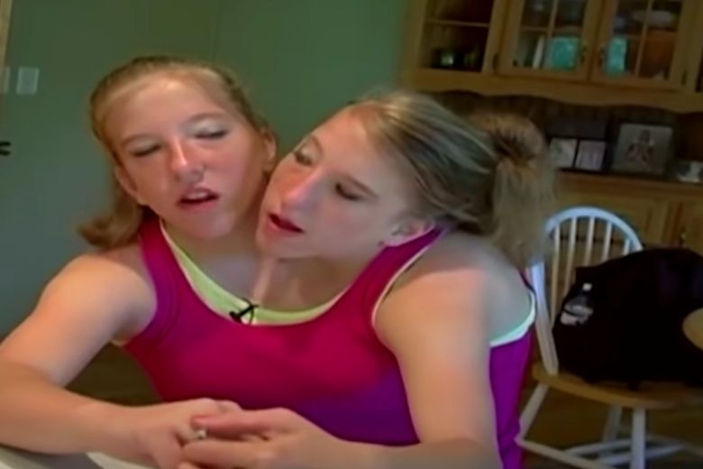 Siamese-tweeling-nieuws