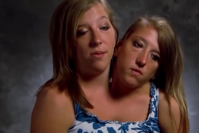 Siamese-tweeling-nieuws